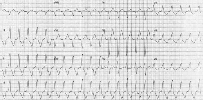 Read more about the article ECG Case 254