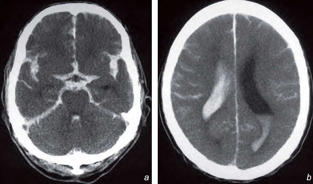 Read more about the article Loss of Conscious after Severe Headache