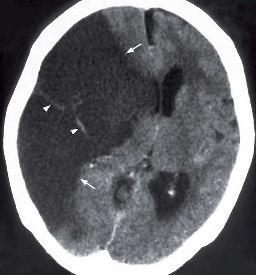 Acute Right MCA Territory Cerebral Infarct