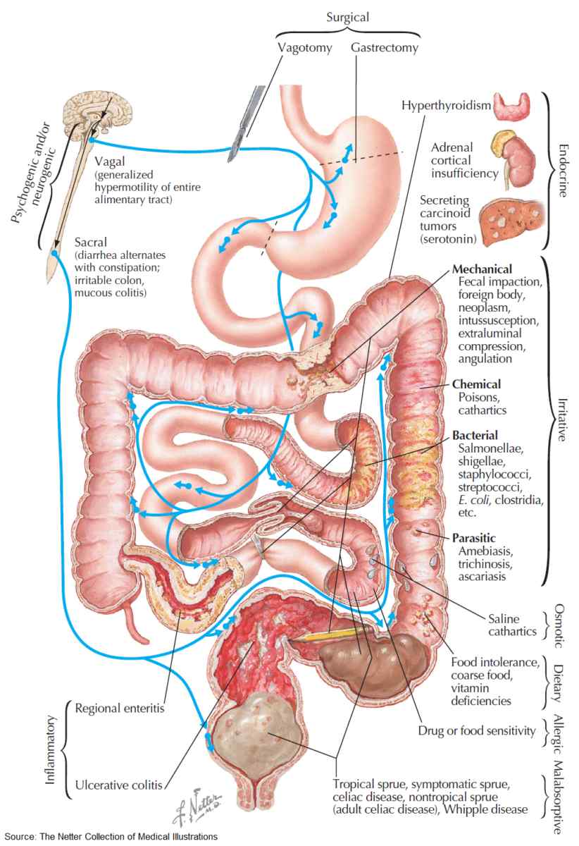 Read more about the article Diagnosing Diarrhea: From Acute to Chronic