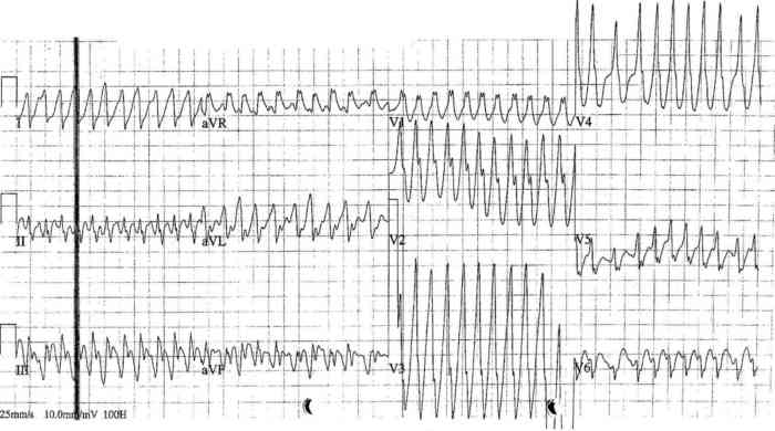 Read more about the article ECG Case 269