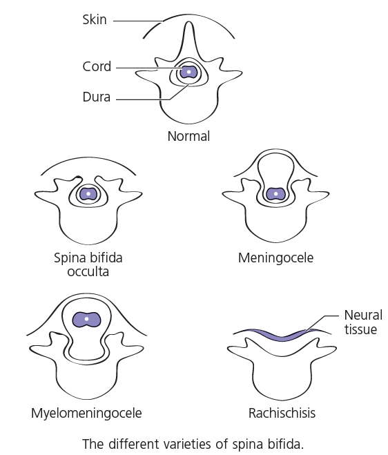 The different varieties of spina bifida