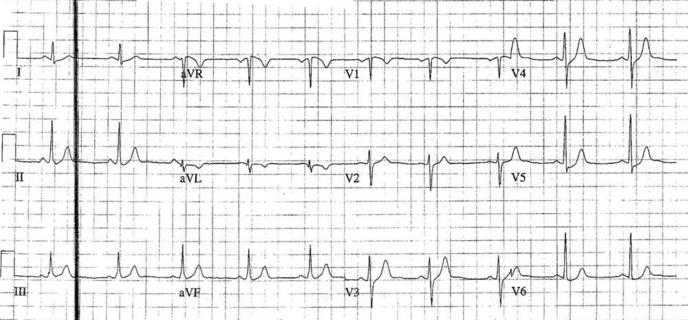 PR shortening and subtle delta wave in the inferior leads