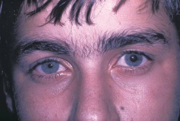 Read more about the article A Boy With a Droopy Eyelid