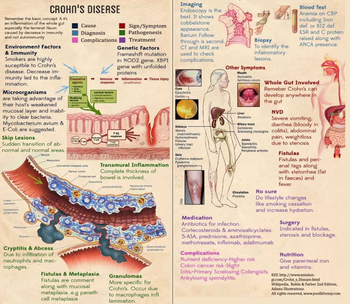 Crohn's Disease - Summary (Overview)