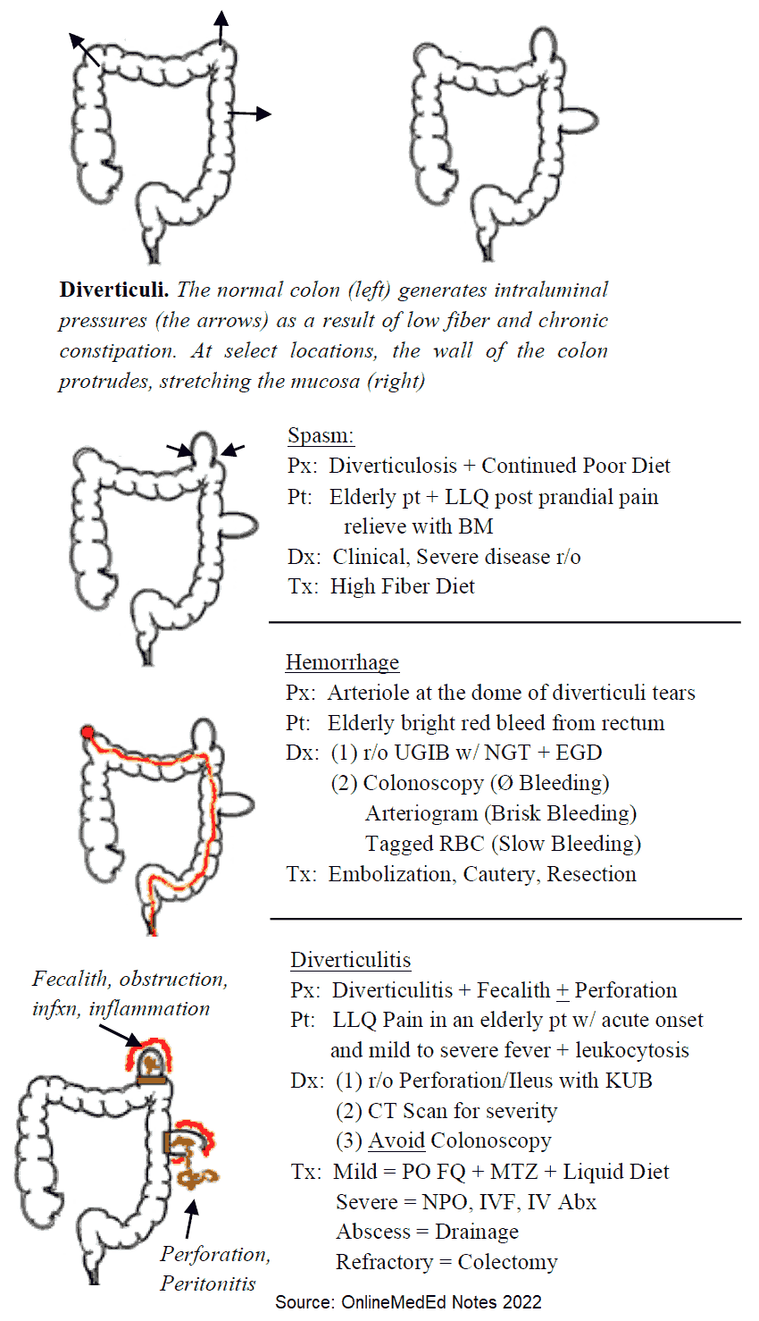 Diverticulosis Complications