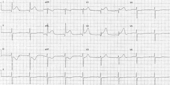 Read more about the article ECG Case 271