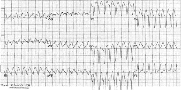Read more about the article ECG Case 274