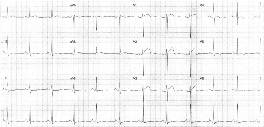 Read more about the article ECG Case 276