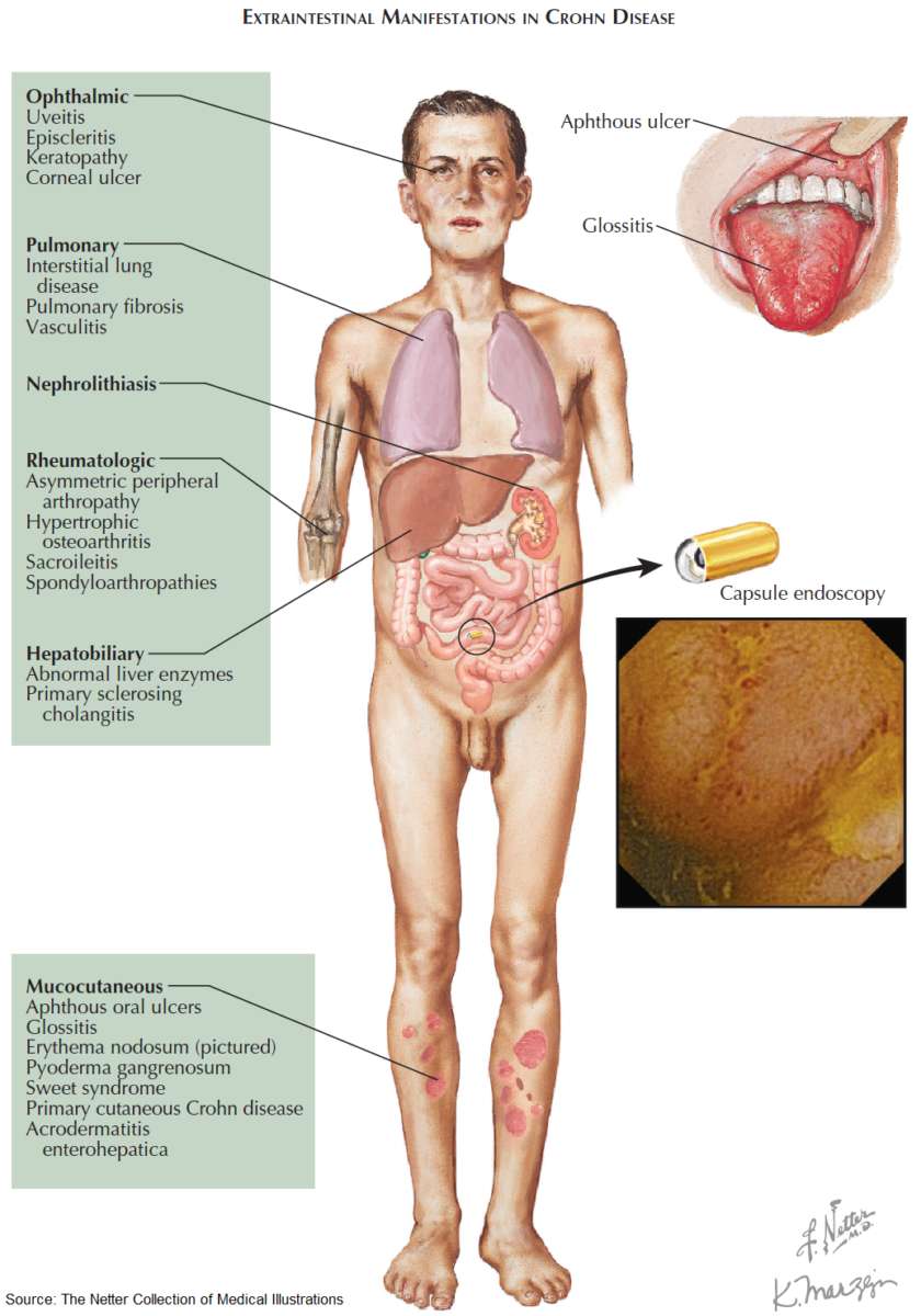 Extraintestinal Manifestations in Crohn Disease
