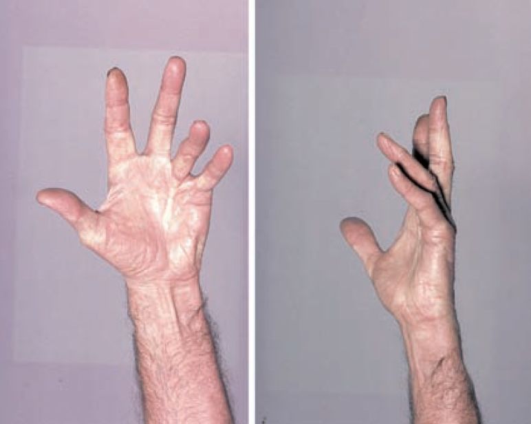Read more about the article Hand Deformity