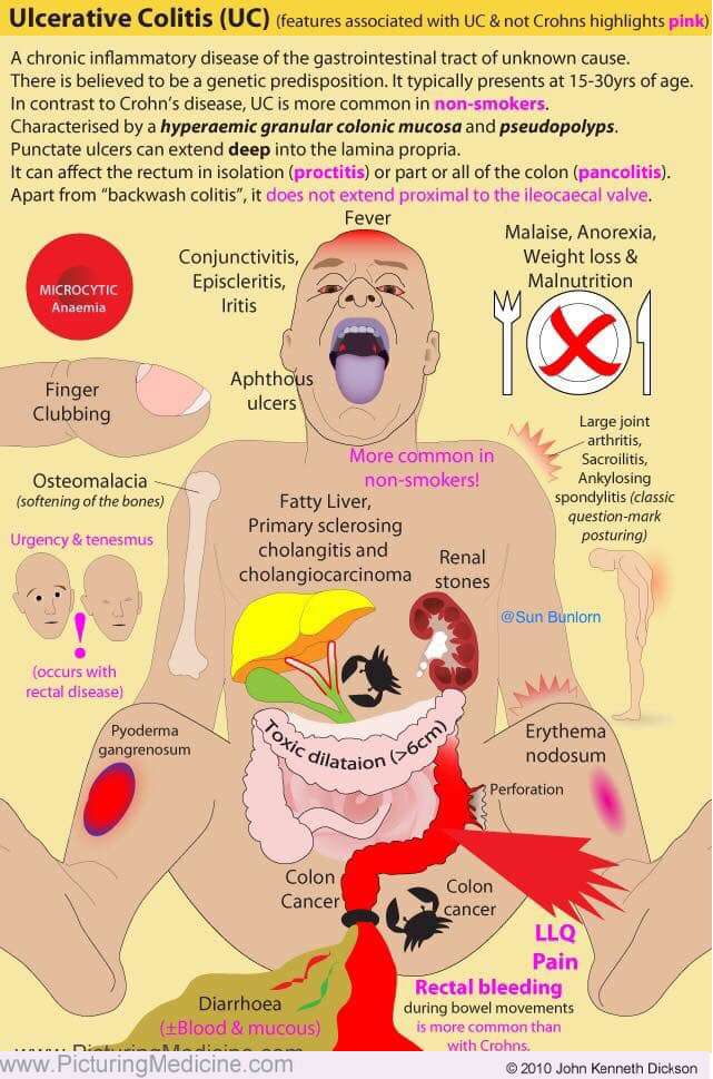 Ulcerative Colitis - Symptoms and Signs