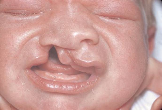 Read more about the article A Baby With Two Gross Congenital Deformities