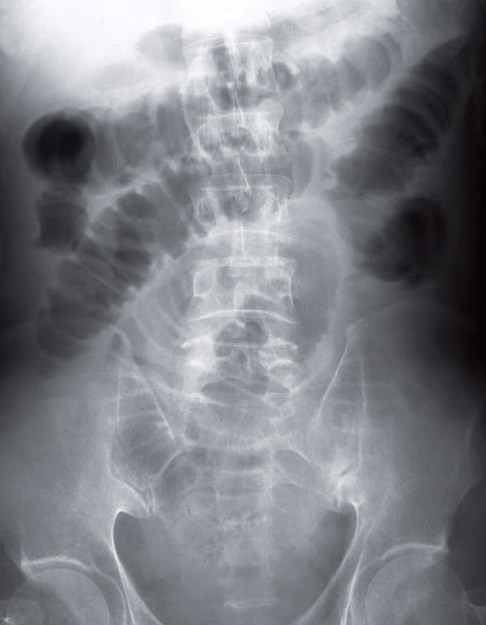 Small Bowel Obstruction