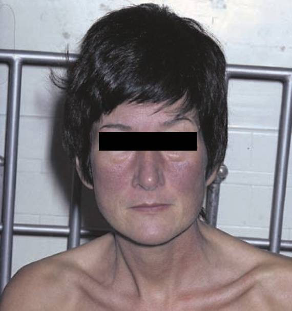 Carcinoid Syndrome