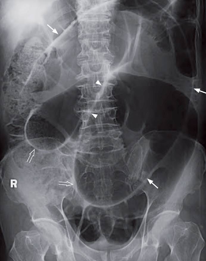 Supine abdominal radiograph showing grossly dilated sigmoid colon (arrows) with the ‘coffee bean’ sign (arrowheads) and inferior convergence sign of sigmoid volvulus (open arrows).