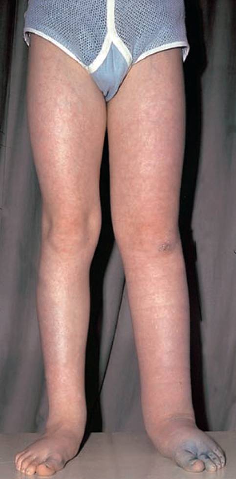 Primary Lymphoedema (Lymphoedema praecox)
