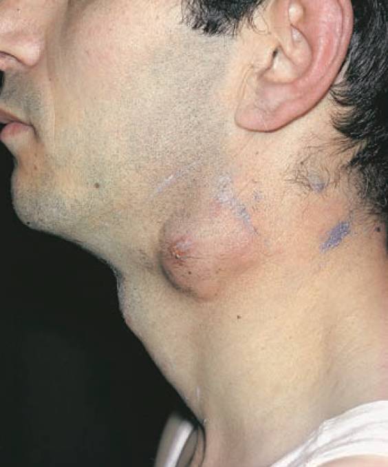 Tuberculous ‘Cold’ Abscess