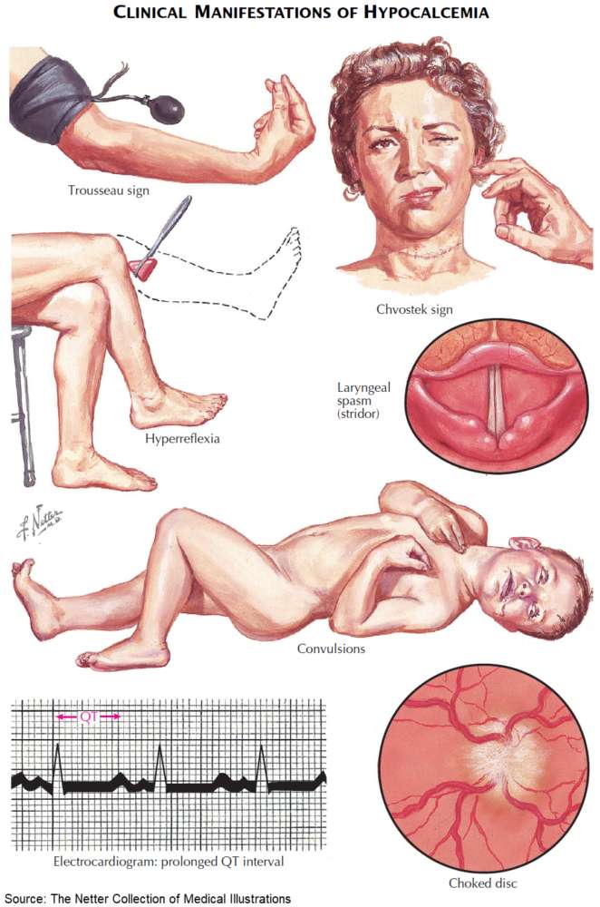 Clinical Manifestations of Hypocalcemia