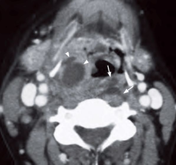 Contrast enhanced axial CT of the neck shows soft tissue thickening and pus collections in retropharyngeal space and right hypopharynx
