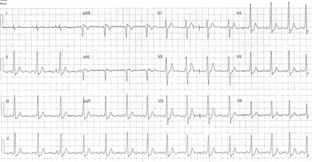 ECG Post Valsalva Maneuver