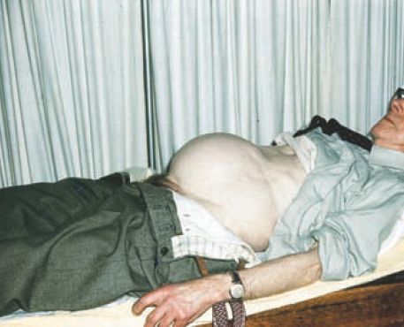Read more about the article Patient with a very Distended Bladder