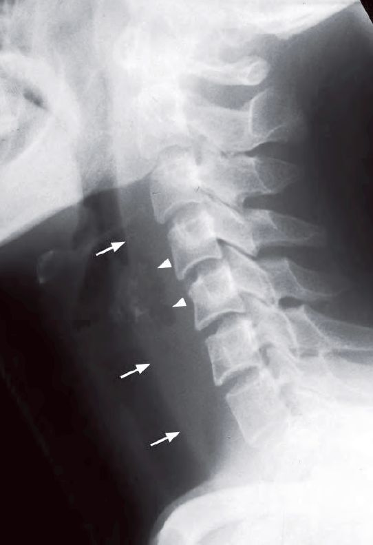 Read more about the article Severe Sore Throat, Painful Swallowing and Fever