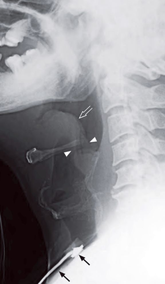 Acute epiglottitis