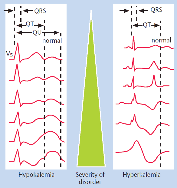 Typical ECG changes with potassium disorders (hypokalemia and hyperkalemia) depending on the degree of severity