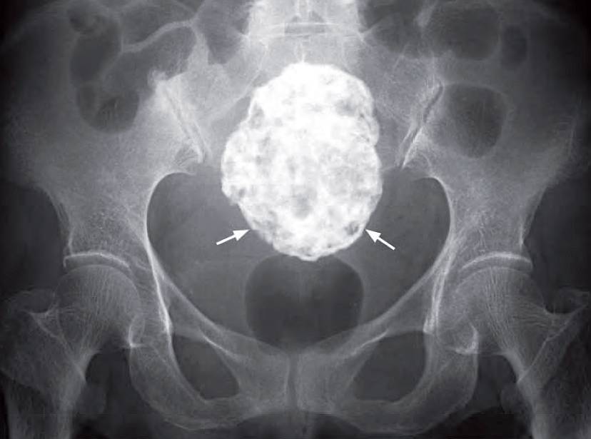 A coned down KUB shows a large calcified mass in the pelvis, which is typical for a large calcified fibroid.