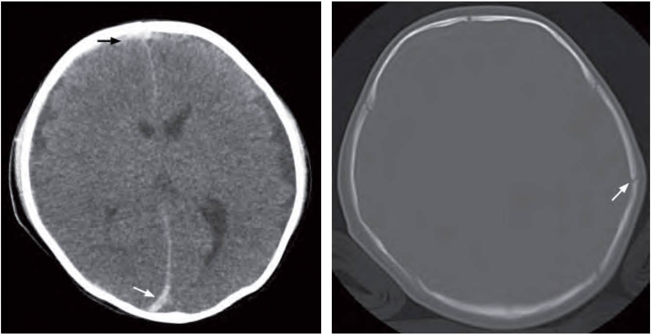 Read more about the article 1-year-old Baby With Decreased Conscious Level and Vomiting