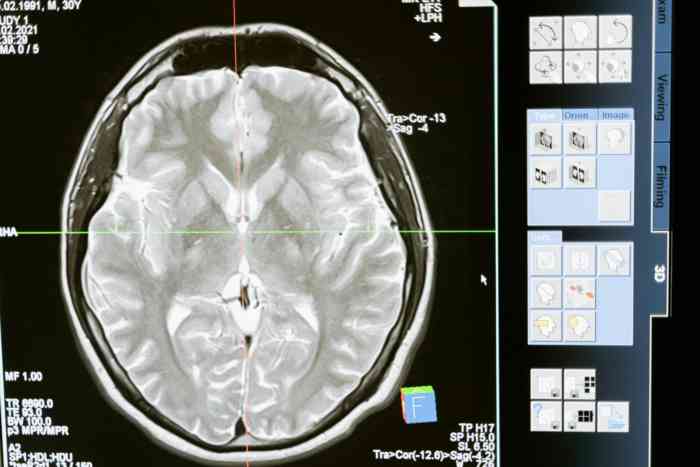 Read more about the article Chronic Neurodegenerative Disorders: Diagnosis and Treatment