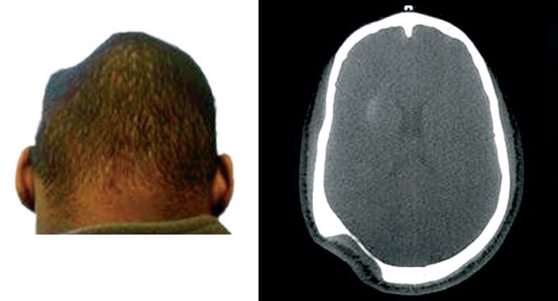 Read more about the article A Dent in the Head