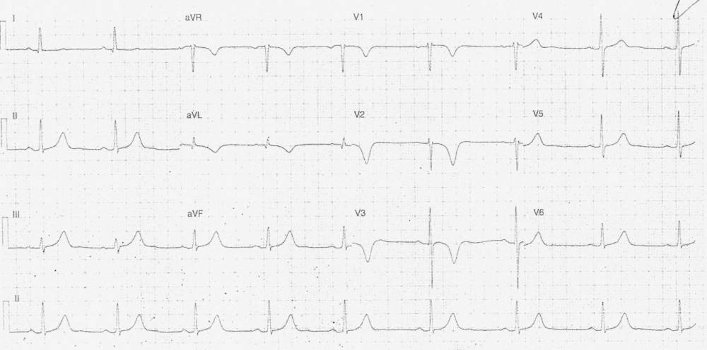 Read more about the article ECG Case 292