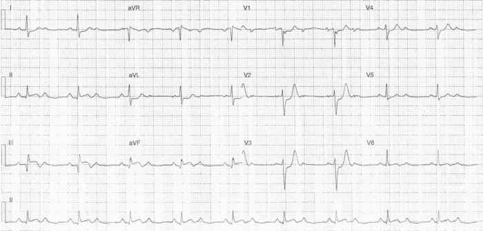 Read more about the article ECG Case 293