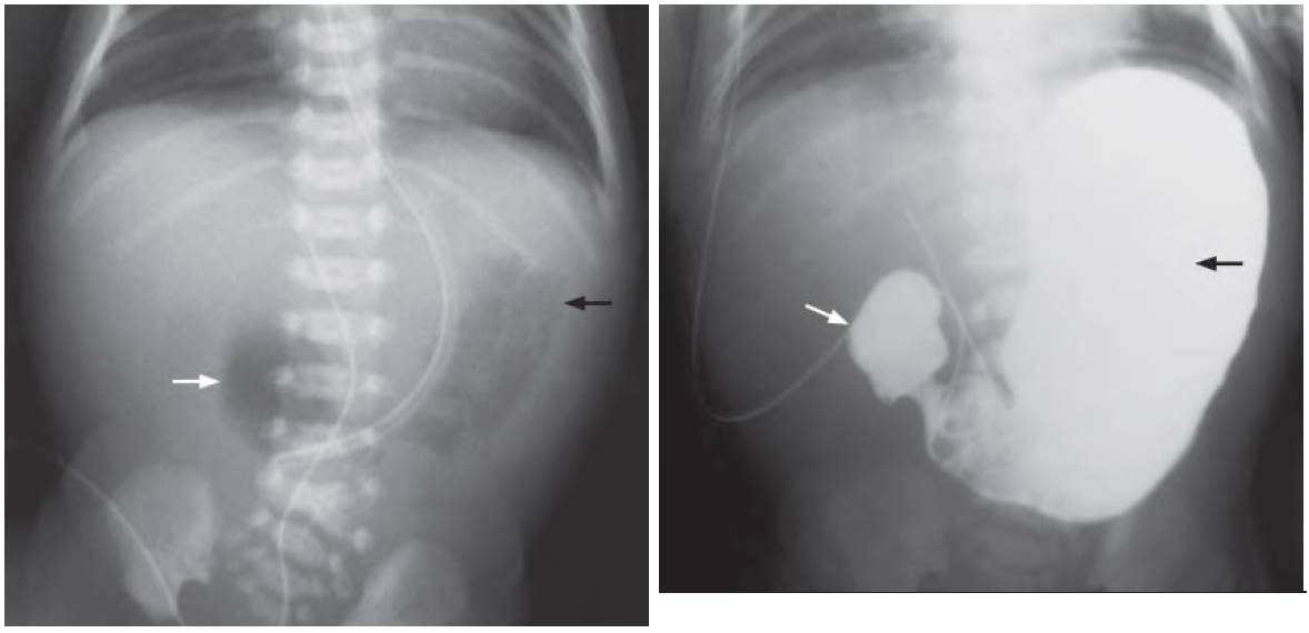 Read more about the article Neonate with Repeated Bile-Stained Vomiting