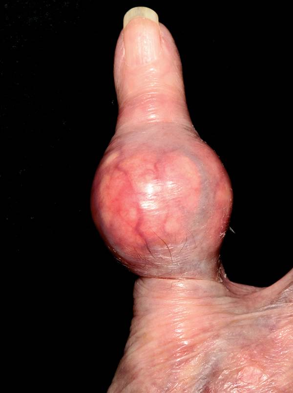 Read more about the article Painless Swollen Joint