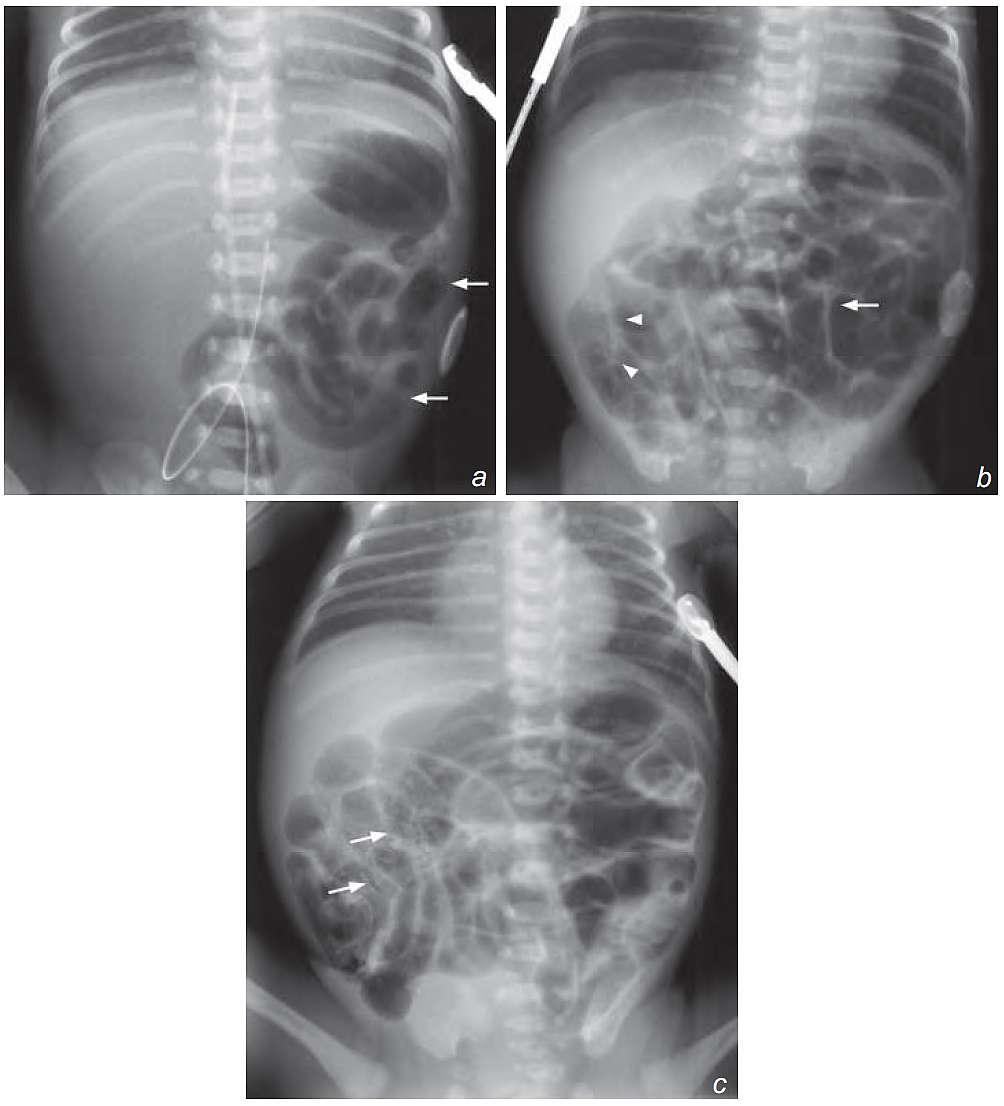 Read more about the article Premature Neonate with Abdominal Distension and Blood in Stool