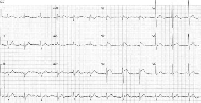 Read more about the article ECG Case 298