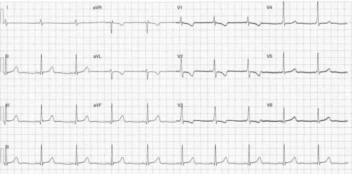 Read more about the article ECG Case 299