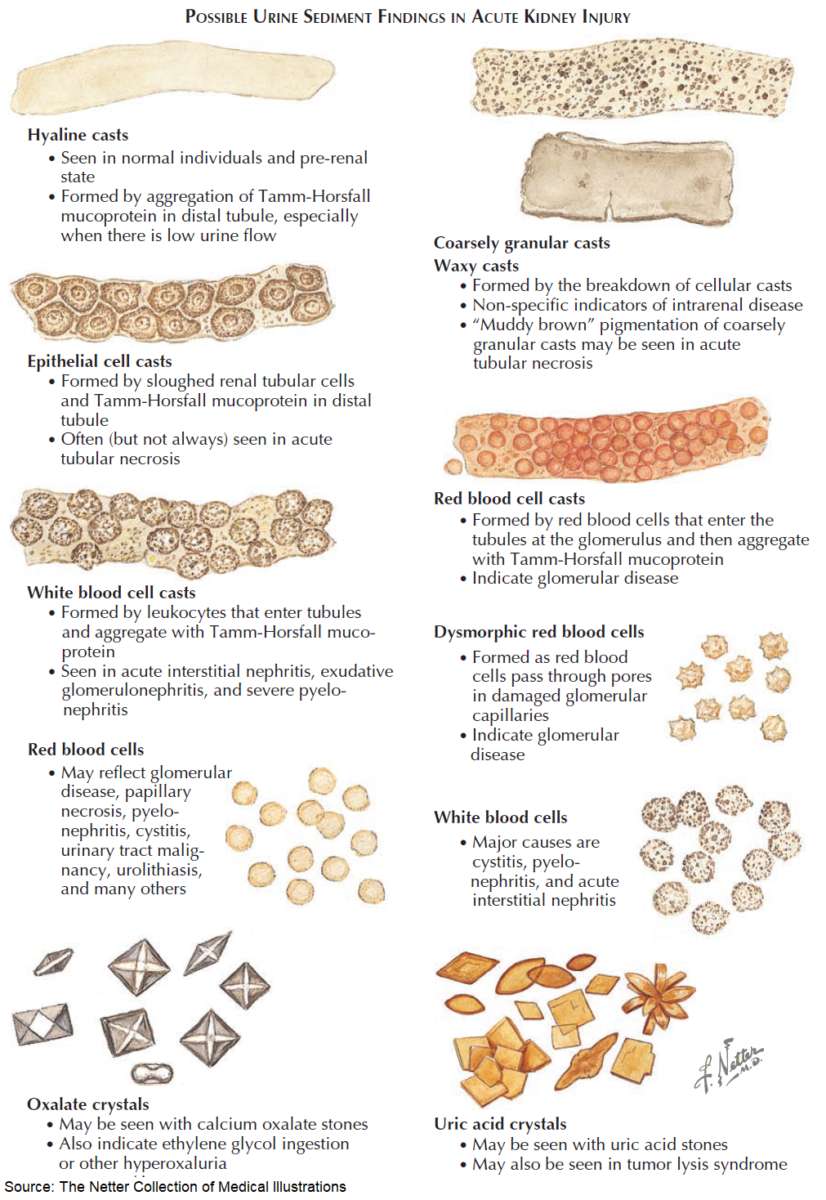 Possible Urine Sediment Findings in Acute Kidney Injury