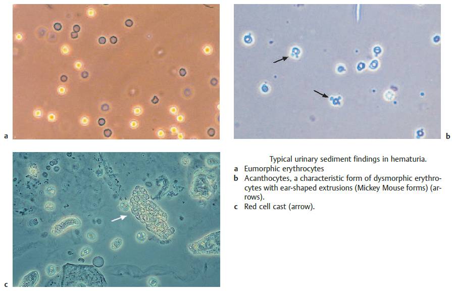 Typical urinary sediment findings in hematuria