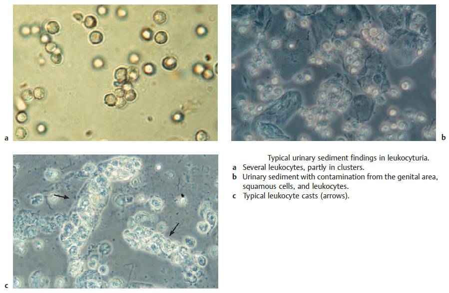 Typical urinary sediment findings in leukocyturia