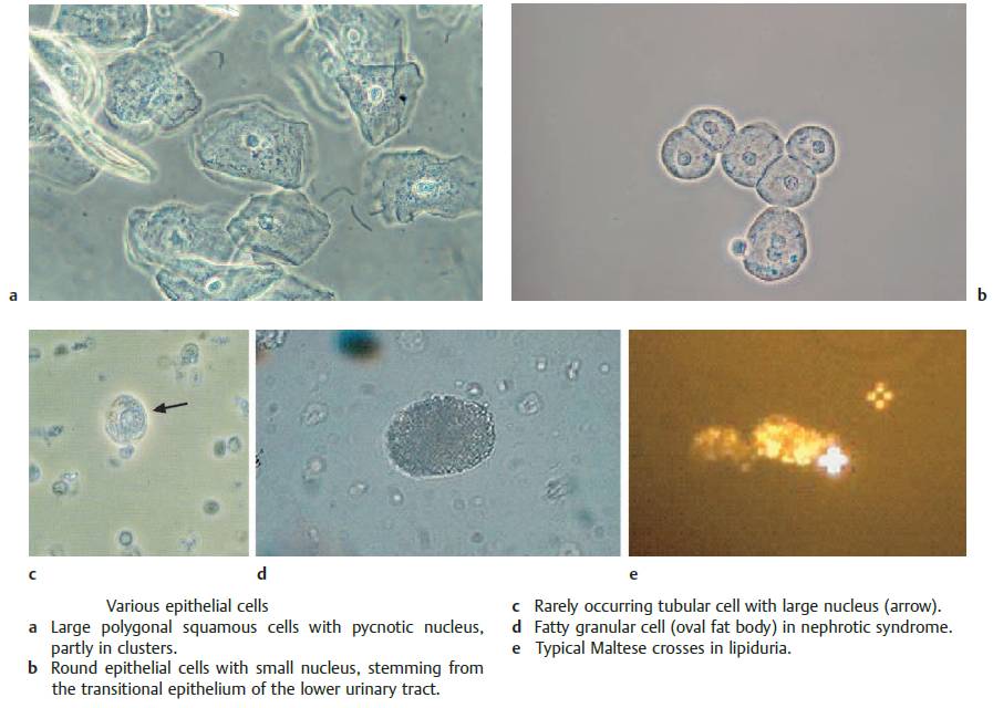 Various epithelial cells in urinary sediment