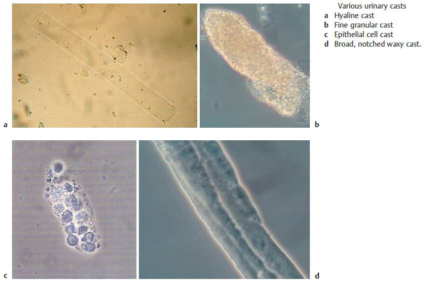 Various urinary casts in urinary sediment