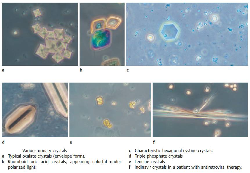 Various urinary crystals in urinary sediment