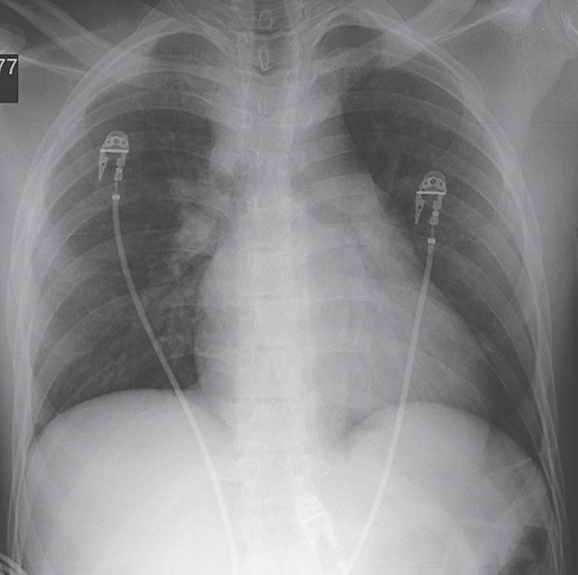 Read more about the article 19-year-old Man After a Motor Vehicle Collision