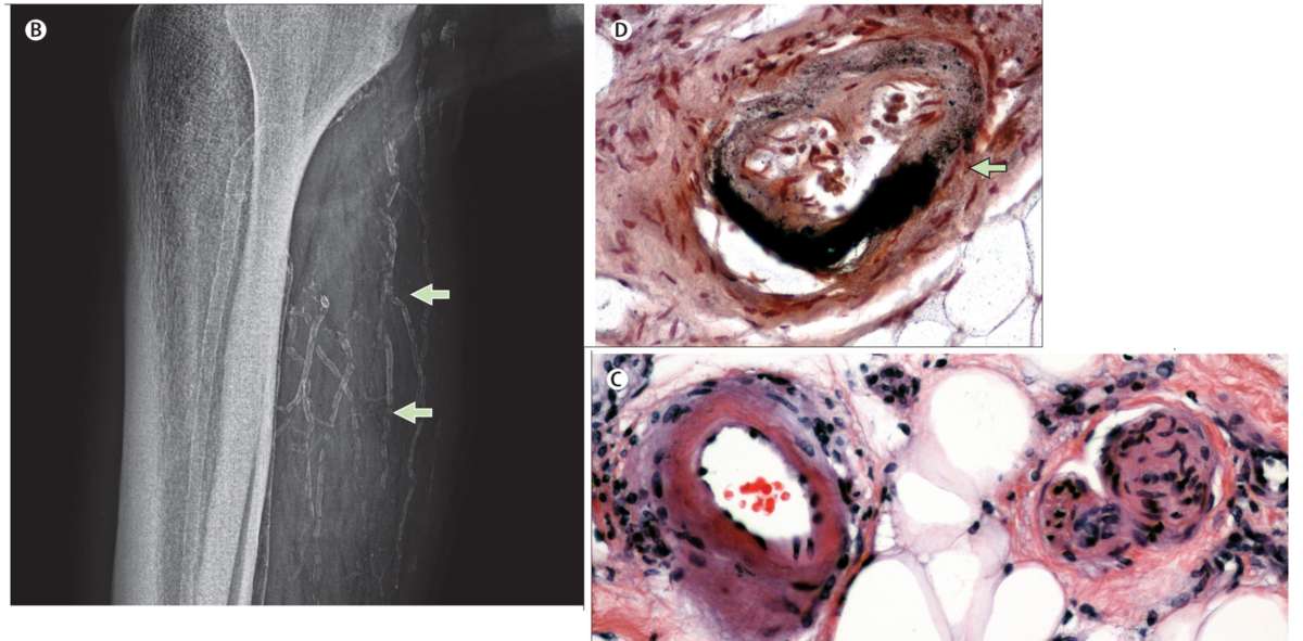 Calciphylaxis