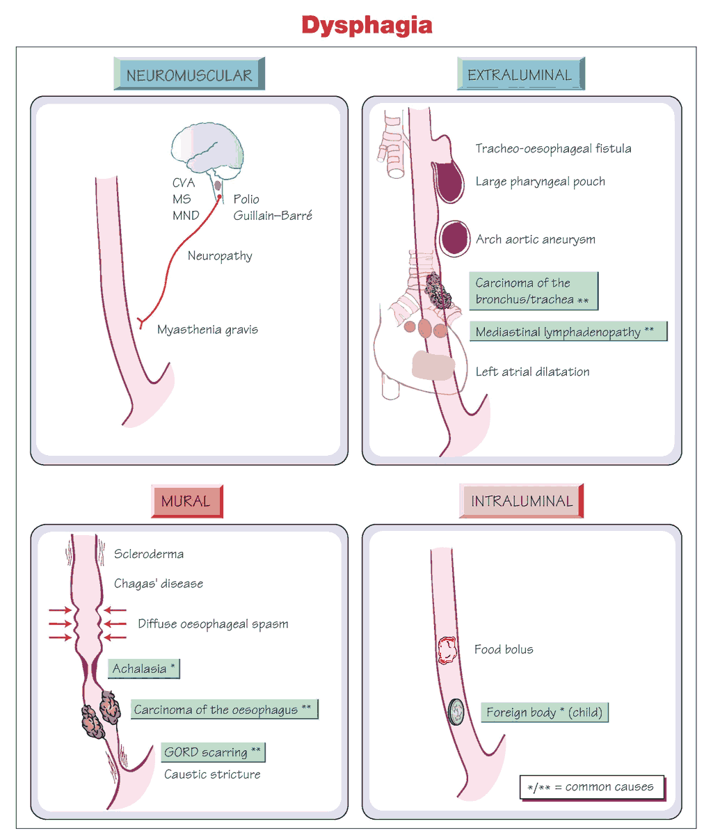 Dysphagia (Difficulty Swallowing) - Causes