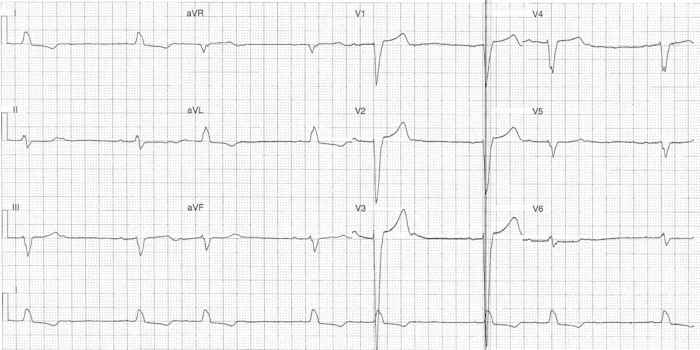 Read more about the article ECG Case 302